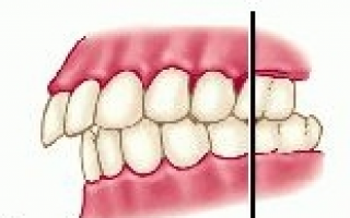 Удаление 4 зуба сверху