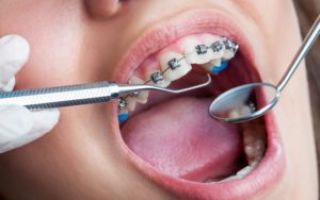После установки брекетов болят зубы что делать