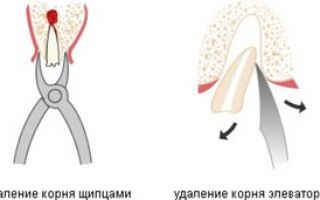 Удаление остатков зуба
