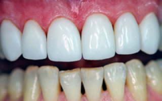 Болит зуб под коронкой причины