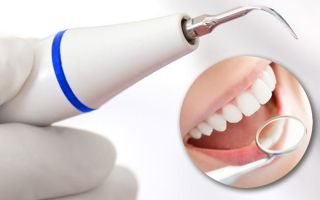 Удаление зубного камня при помощи ультразвука
