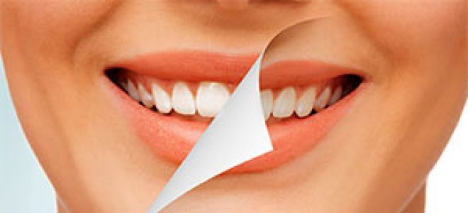 Как снимают зубной камень в стоматологии