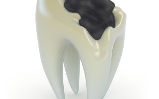 Почему зубы разрушаются: основные факторы и способы решения проблемы