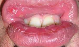 Болячка под нижней губой