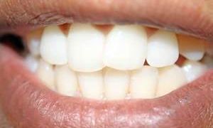Зубная эмаль восстанавливается