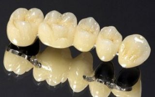 Как делают зубные мосты