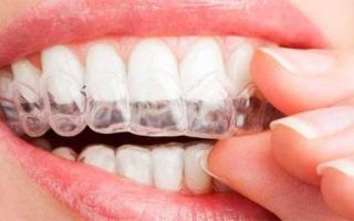 Как действуют брекеты на зубы