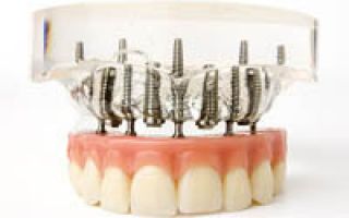 Имплантирование зубов