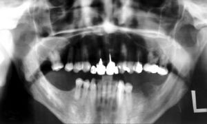 Воспаление в кости зуба