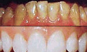 Зубной камень лечение