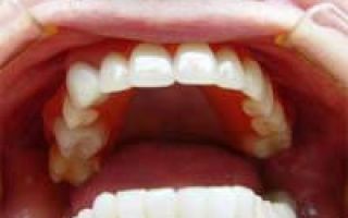 Какие протезы лучше при полном отсутствии зубов