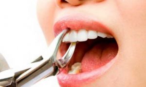 Можно ли при месячных удалять зуб
