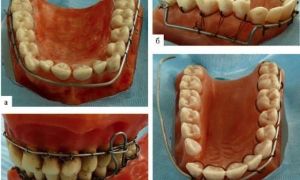 Шинирование зубов при пародонтите