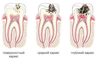 Какие болезни зубов встречаются чаще всего?